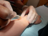 Lokalanästhesie mit ultrafeiner Nadel